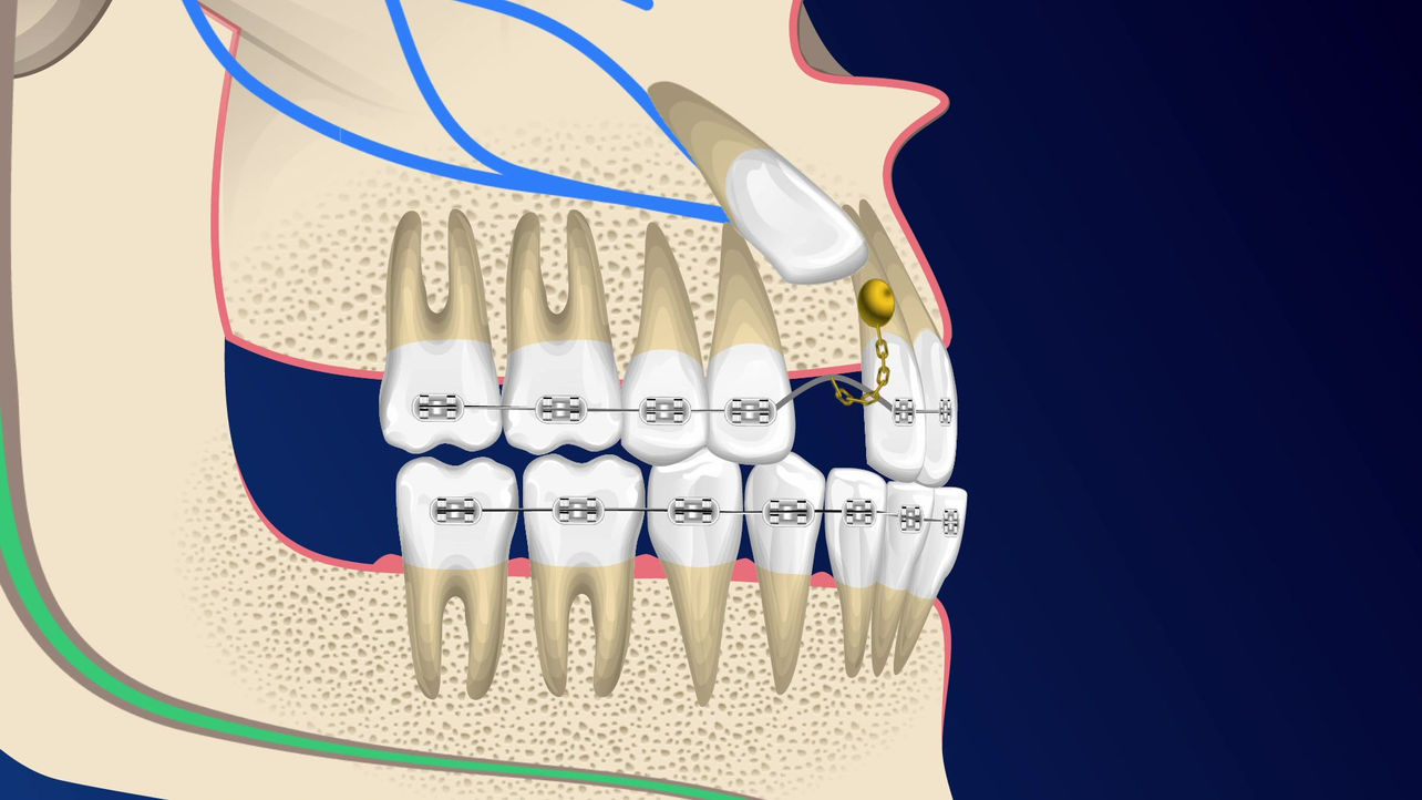 Exposure and Bond Surgery